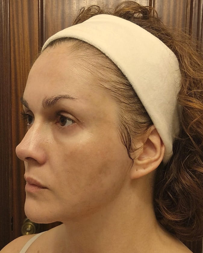 Esther Gaya después del tratamiento