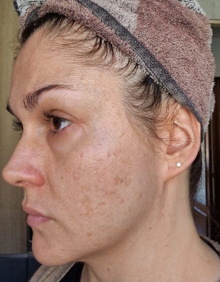 Esther Gaya antes del tratamiento